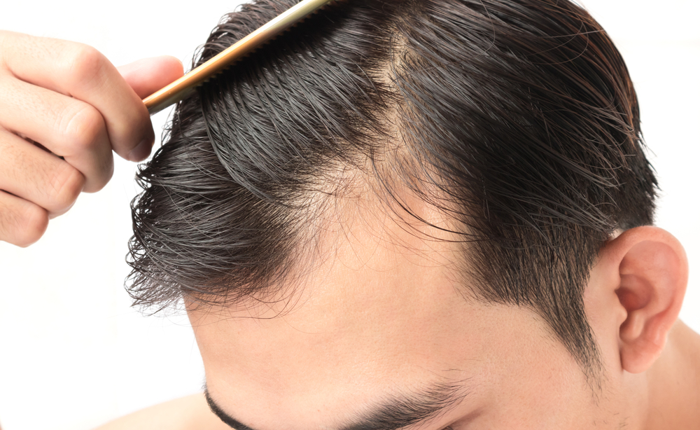 How many PRP treatment do I need for hair loss?