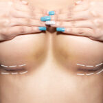 breast reconstruction How to Recognize and Prevent Common Breast Implant Complications