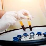 The Importance of a Good PRP Centrifuge for PRP Treatment
