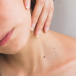 NHS Calendar: Skin Cancer Awareness Month