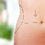 Body Contouring Surgeries and Treatments