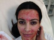 Why the Science Behind Kim Kardashian’s ‘Vampire Facial’ Remains Popular