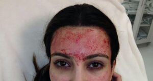 Why the Science Behind Kim Kardashian’s ‘Vampire Facial’ Remains Popular