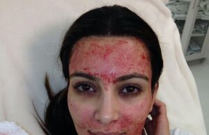 Why the Science Behind Kim Kardashian’s ‘Vampire Facial’ Remains Popular