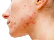 How Laser Treatment Helps Clear Acne and Fade Hyperpigmentation