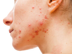 How Laser Treatment Helps Clear Acne and Fade Hyperpigmentation