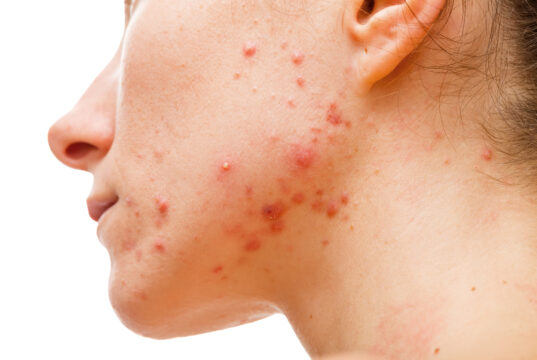 How Laser Treatment Helps Clear Acne and Fade Hyperpigmentation