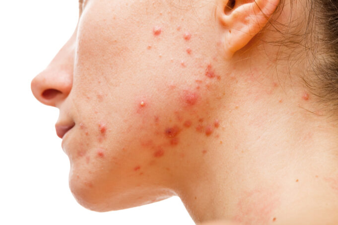 How Laser Treatment Helps Clear Acne and Fade Hyperpigmentation