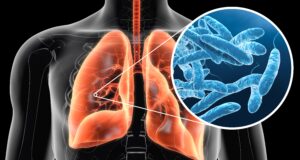 A Look at Legionnaires’ Disease After UK Tourist Falls Ill in Greece