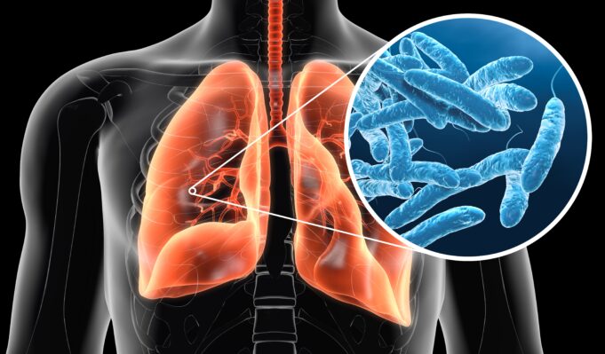 A Look at Legionnaires’ Disease After UK Tourist Falls Ill in Greece