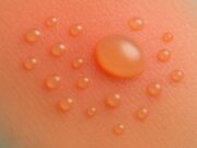 What Are Sun Blisters and Why Do They Form?