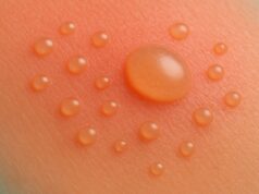 What Are Sun Blisters and Why Do They Form?