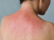 Suffering in the Heat? How to Soothe Prickly Heat Fast This Summer