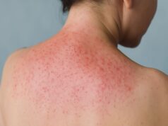 Suffering in the Heat? How to Soothe Prickly Heat Fast This Summer
