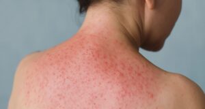 Suffering in the Heat? How to Soothe Prickly Heat Fast This Summer