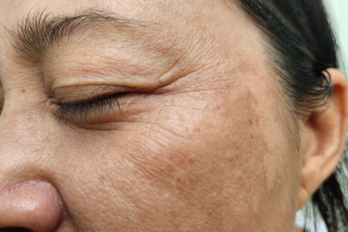 the story of wrinkles - what different wrinkles mean