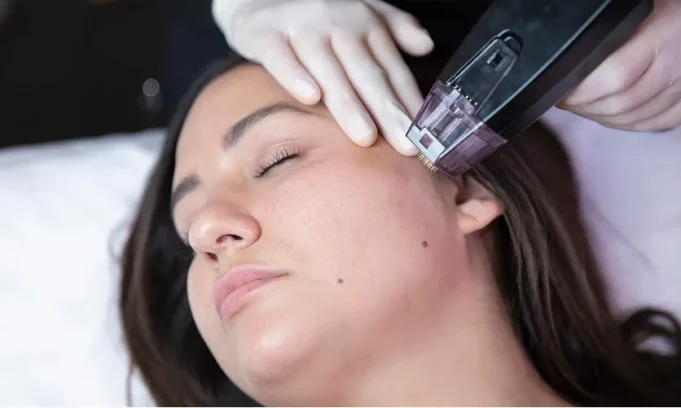 Morpheus- Skin Rejuvenation by Dr.Marwah Exosome Skin Therapy