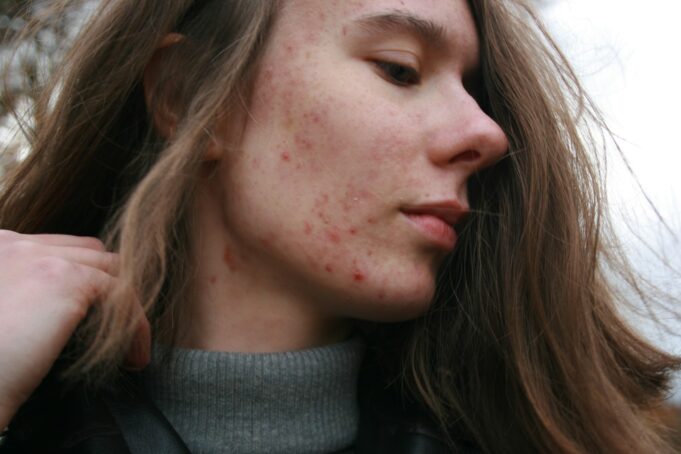 Soothing Treatments for Winter Rosacea Flare-Ups