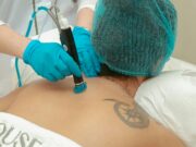 Tattoo Removal Tech: The 2026 Regret Industry Boom Tattoo Removal Tech: The 2025 Regret Industry Boom