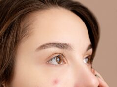 The Gut-Skin Connection: 5 Signs Your Diet Is Triggering Your Summer Breakouts