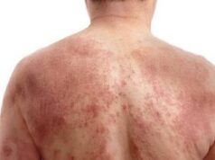 Red Skin Syndrome: The Warning Signs You’re Dealing with Steroid Dependency, Not an Eczema Flare Red Skin Syndrome: The Warning Signs You are Dealing with Steroid Dependency, Not an Eczema Flare