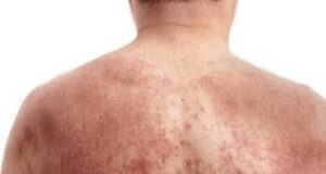 Red Skin Syndrome: The Warning Signs You are Dealing with Steroid Dependency, Not an Eczema Flare