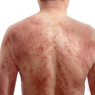 images (5) Red Skin Syndrome: The Warning Signs You are Dealing with Steroid Dependency, Not an Eczema Flare