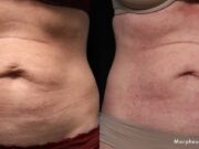 The Loose Skin Dilemma: When Do You Need Surgery vs. Non-Invasive Body Contouring? The Loose Skin Dilemma: Surgery vs. Contour