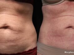 The Loose Skin Dilemma: When Do You Need Surgery vs. Non-Invasive Body Contouring? The Loose Skin Dilemma: Surgery vs. Contour