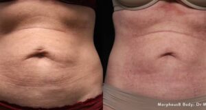 The Loose Skin Dilemma: Surgery vs. Contour