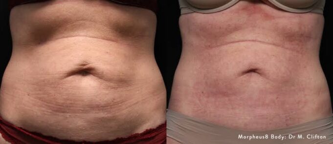 images (6) The Loose Skin Dilemma: Surgery vs. Contour