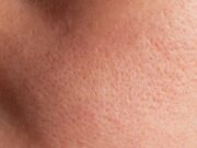 The Secret to Minimising Large Pores: A Nurse’s Real-Life Protocol for Flawless Texture The Secret to Minimising Large Pores: A Nurse's Real-Life Protocol for Flawless Texture