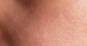 The Secret to Minimising Large Pores: A Nurse's Real-Life Protocol for Flawless Texture