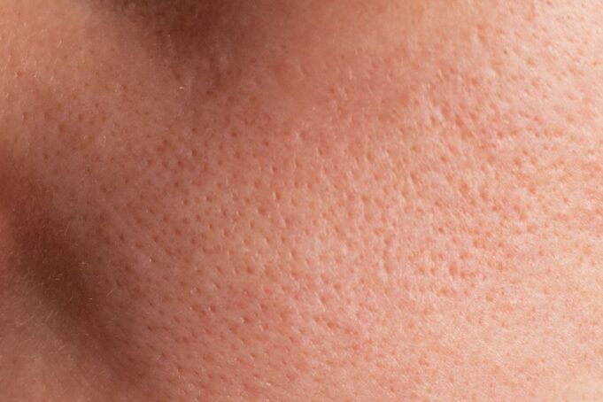 The Secret to Minimising Large Pores: A Nurse's Real-Life Protocol for Flawless Texture The Secret to Minimising Large Pores: A Nurse's Real-Life Protocol for Flawless Texture