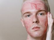 Beyond the Cream: Why TSW (Topical Steroid Withdrawal) is Dominating Patient Support Groups Beyond the Cream: Why TSW (Topical Steroid Withdrawal) is Dominating Patient Support Groups