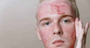 Beyond the Cream: Why TSW (Topical Steroid Withdrawal) is Dominating Patient Support Groups