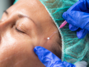 What is a Barbed Thread Lift? The Non-Surgical Treatment Redefining the Jawline What is a Barbed Thread Lift? The Non-Surgical Treatment Redefining the Jawline