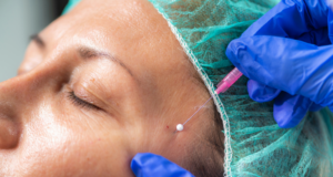 What is a Barbed Thread Lift? The Non-Surgical Treatment Redefining the Jawline