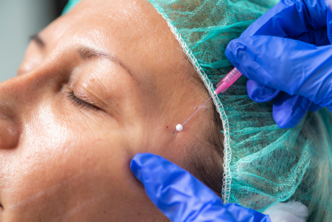 What is a Barbed Thread Lift? The Non-Surgical Treatment Redefining the Jawline
