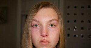 Is 'Cortisol Face' Real? The Science Behind the Viral Puffy-Face Theory