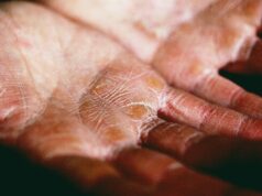 The Next Frontier in Eczema Care: Biologics and Non-Steroidal Topicals Changing the Game The Next Frontier in Eczema Care: Biologics and Non-Steroidal Topicals Changing the Game