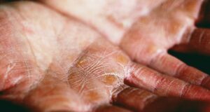 The Next Frontier in Eczema Care: Biologics and Non-Steroidal Topicals Changing the Game