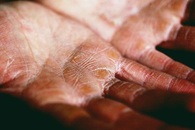 The Next Frontier in Eczema Care: Biologics and Non-Steroidal Topicals Changing the Game