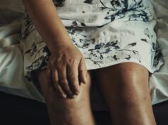 Sclerotherapy for Spider and Varicose Veins: What Actually Happens During Treatment