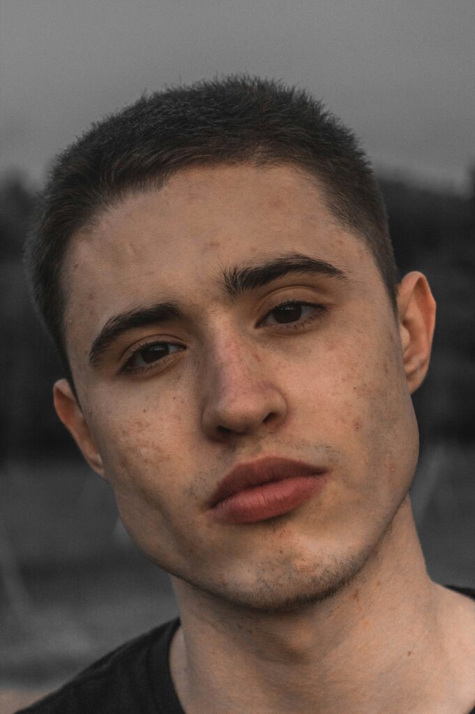 nikolay-vybornov-lC6f79utuKM-unsplash Is Your Gut Triggering Your Acne? 5 Signs Your Diet Is Causing Summer Breakouts