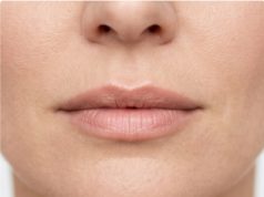 Lip Filler Gone Wrong? Here’s How It Gets Fixed Lip Filler Gone Wrong? Here's How It Gets Fixed