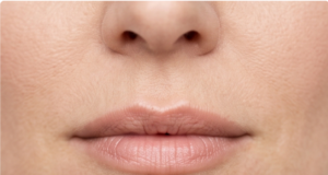Lip Filler Gone Wrong? Here's How It Gets Fixed