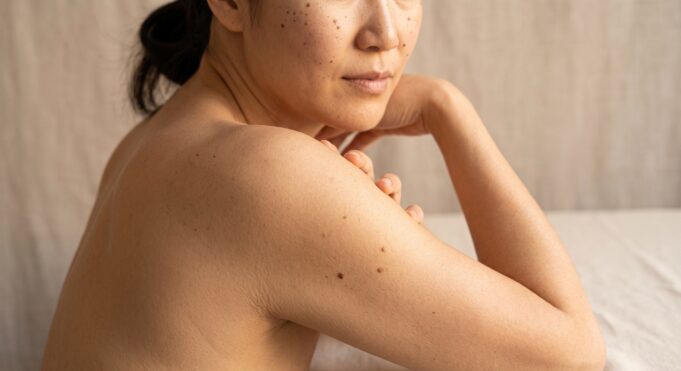 Cellulite and Stretch Marks: Fact vs Fad