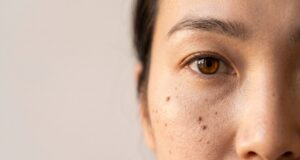 Under-Eye Hollows: Why Filler Isn't Always the Fix